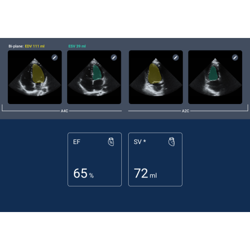 Ejection Fraction