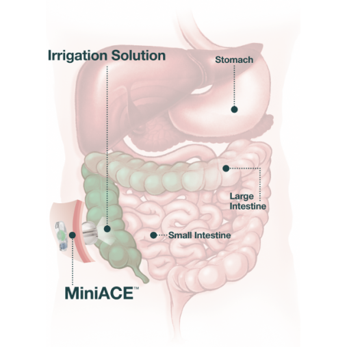 MiniACE® Enema Button